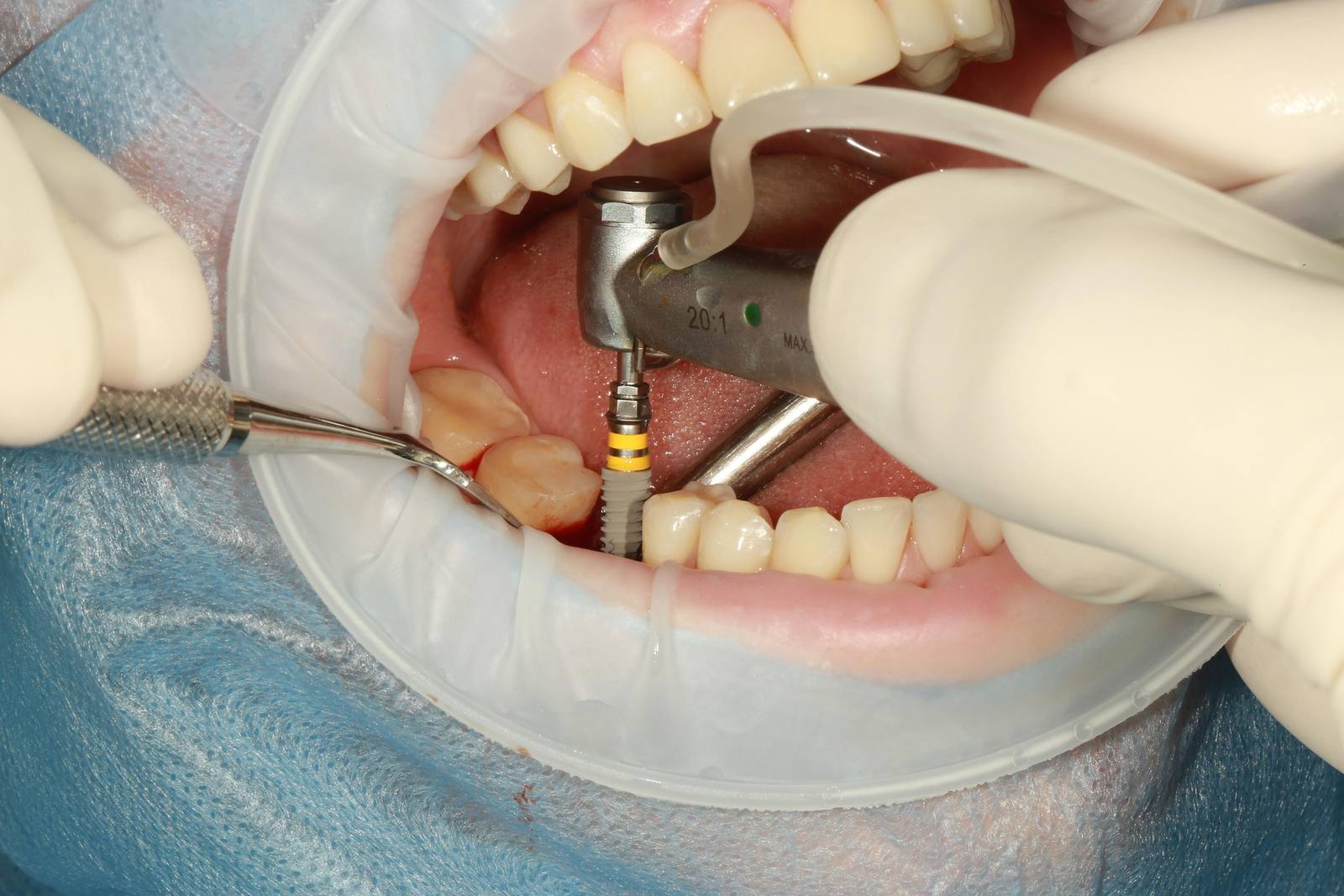Root canal treatment